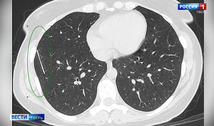 В Твери женщина несколько лет жила с иглой в легком 